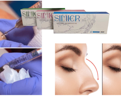 Transparente 10 ml Natriumhyaluronat Gel Injektionsbehandlung zur Füllung von Lächellinien