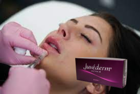 Weiblicher Hyaluronsäure-Füllstoff mit Querverknüpfung Juvederm Lippenfiller Ultra 3 Ultra 4