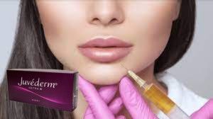 Juvederm Ultra 3 Hyaluronsäure HA Hautfüllmittel 2 ml Lippenvergrößerung
