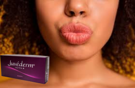 Juvederm Ultra 3 Hyaluronsäure HA Hautfüllmittel 2 ml Lippenvergrößerung