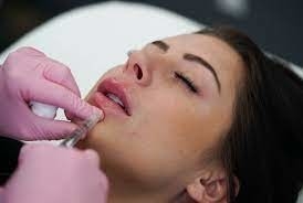 GMP Juvederm Ultra 3 HA Hautfüllmittel für Lippen